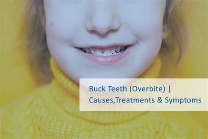 Does buck teeth affect speech?