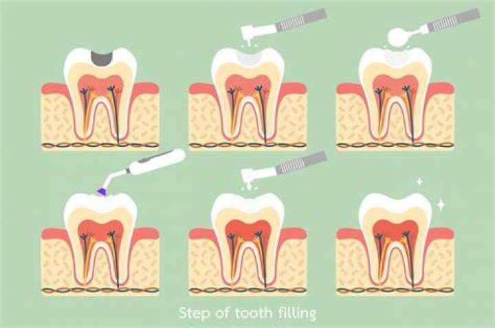Does it pain after tooth filling?