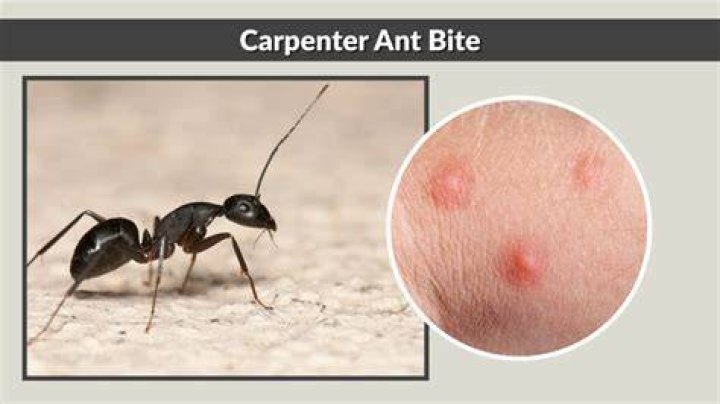 In an ant bite?