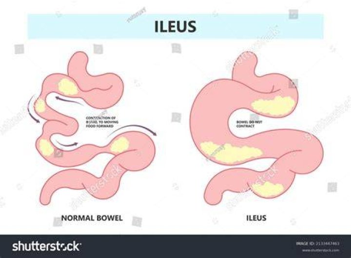 Where does an ileus occur?